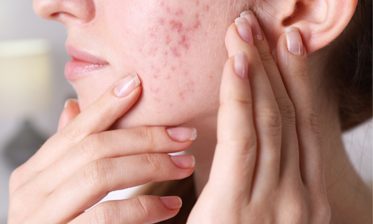 ¿Qué es el acné hormonal y cómo cuidarlo de forma natural?