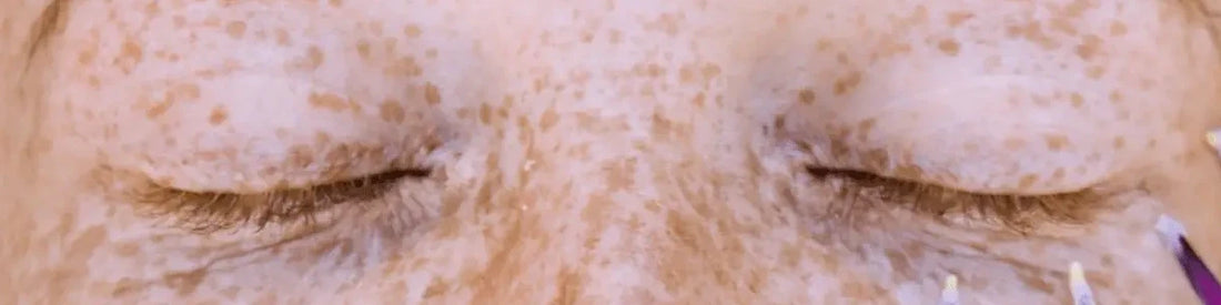 Cómo prevenir y reducir las manchas en la piel de forma natural