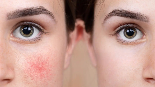 Rojeces en la Cara: Causas y Cómo Reducirlas con Cosmética Natural